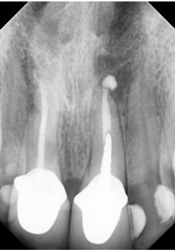 6 Month Re-call #9