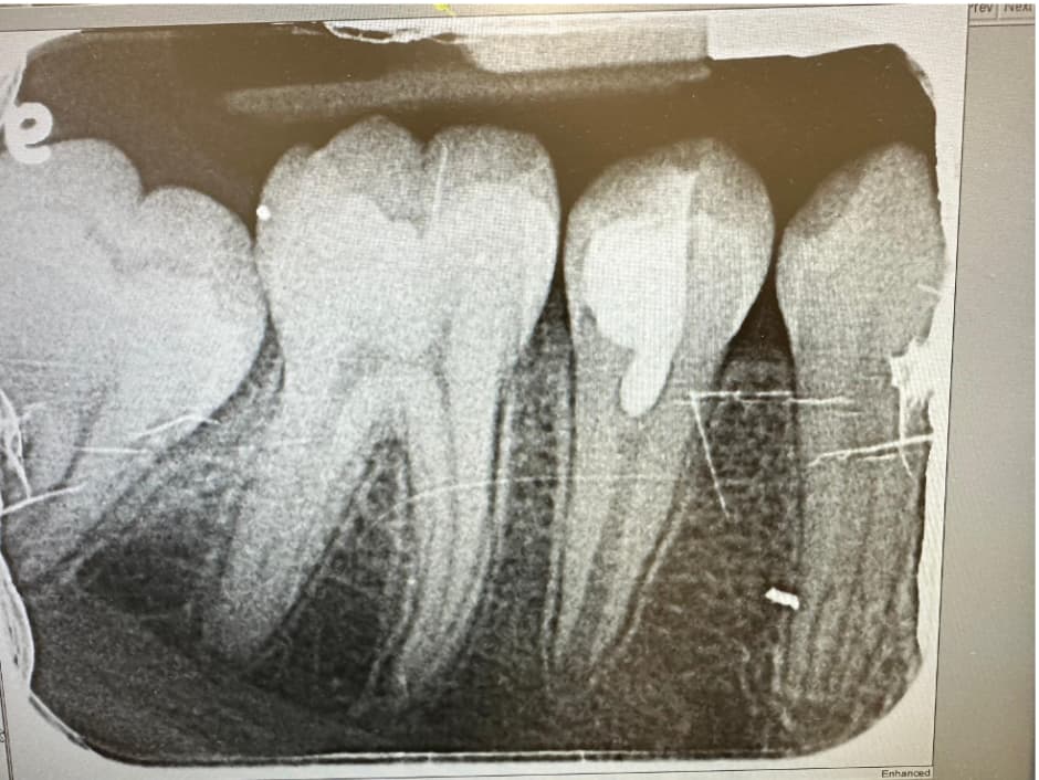 6 Month Re-call #29